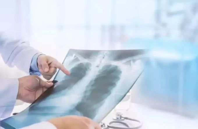 ¿Cómo solicito mi radiografía de tórax sin cargo?